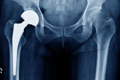 Hip Replacement